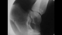 X-ray movements of ankle joints, 1960s Stock Footage