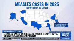 Measles cases on rise amid public health cuts, growing vaccine skepticism News Clip