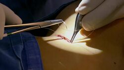 Surgeon doing surgical suture or stitches on chest after removing cartilage for nasal septum deviation and rhinoplasty surgery on female patient. Female patient under general anesthesia. Stock Footage