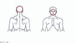 Seborrheic Dermatitis (Dandruff and Cradle Cap) Causes, Risk Factors, Symptoms, Diagnosis, Treatment Instructional Video