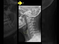 Testing cervical anatomy (X-rays) Part B Instructional Video