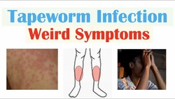 Weird Symptoms of Tapeworm Infection (Skin, Psychological, Neurological) Instructional Video