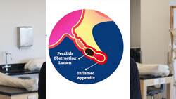 Understanding Appendicitis Instructional Video