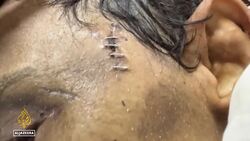 Palestinian Man Returns to Gaza with Life-Threatening Injuries After Alleged Detention by Israeli News Clip