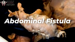 Abdominal Fistula Explained: The Scariest Complication of Abdominal Surgery Instructional Video