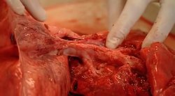 How Science Works: Asthma on the Run: The Effect of Asthma on the Airways Instructional Video