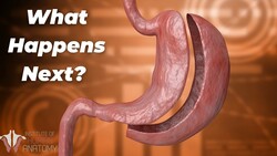 Removing 80% of the Stomach Instructional Video