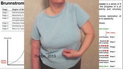 Brunnstrom's Stages of Stroke Recovery Instructional Video