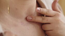 Why Do Healing Wounds Itch? Instructional Video