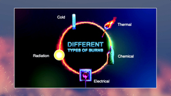 Types of Burns - Thermal, Chemical, Electrical, Radiation and Cold Burns Instructional Video