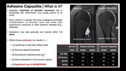 Adhesive Capsulitis (Frozen Shoulder) | Part 1 - Presentation & Pathophysiology Instructional Video