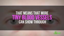 Why Do I Get Dark Circles Under My Eyes? Instructional Video