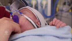 A simple solution for healthier premature babies? News Clip