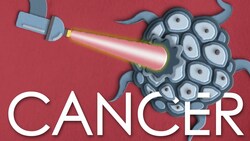 How lasers are used to treat cancer Instructional Video