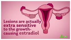 Endometriosis: When Uterine Tissue Goes Rogue Instructional Video