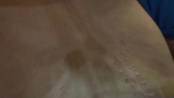 CLEAN : Denied treatment, Russians with rare disorder fight for lives News Clip