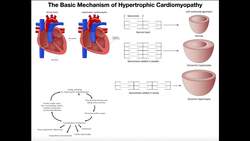 Hypertrophic Cardiomyopathy How the Heart Enlarges Pathologically Instructional Video