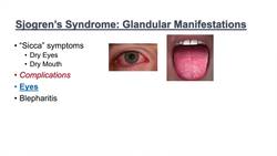 Sjogren’s Syndrome ("Dry Eye Syndrome") | Primary vs. Secondary, Symptoms, Diagnosis and Treatment Instructional Video