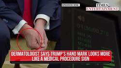 Trump’s Hand Shows STRANGE Bruise; Make-Up or Health Scare? Experts Give Worrying Update News Clip