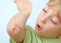 What is a scab? Instructional Video