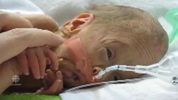 Preemie survival News Clip