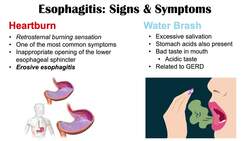 Esophagitis (Esophagus Inflammation) Signs & Symptoms (& Why They Occur) Instructional Video