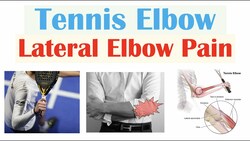 Tennis Elbow (Lateral Epicondylitis) | Causes, Pathophysiology, Symptoms, Diagnosis, Treatment Instructional Video
