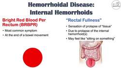 Hemorrhoids Signs & Symptoms | Internal vs. External Hemorrhoid Symptoms | Hemorrhoidal Disease Instructional Video
