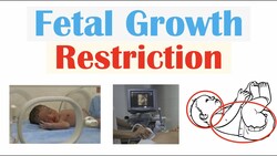 Fetal Growth Restriction (FGR, IUGR) | Types, Causes, TORCH Infections, Diagnosis, Treatment Instructional Video