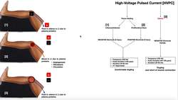 High-Voltage Pulsed Current [HVPC] Theory, Use, & Parameters Instructional Video