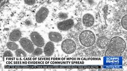 Health officials identify first known case of new, more severe mpox in the US News Clip