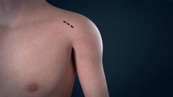 Total Shoulder Replacement Instructional Video