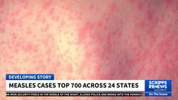 Measles cases surge to six-year high with over 700 confirmed in 24 states News Clip