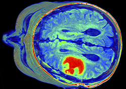 Tumores: el virus que mata o cura Instructional Video