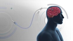 Modified polio virus used to treat brain cancer Instructional Video