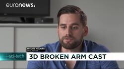 3D printed cast could replace plaster News Clip