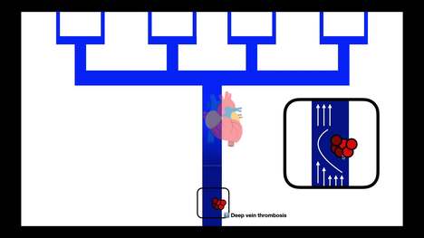 Deep Vein Thromboses [DVTs] & Pulmonary Embolisms [PEs] EXPLAINED