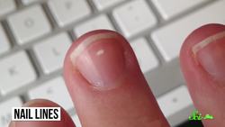 What Are Those Lines on My Nails? Instructional Video