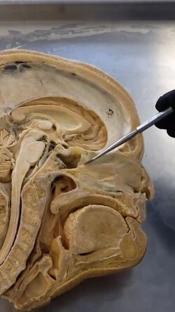 Exploring the Anatomy of the Human Septum Instructional Video