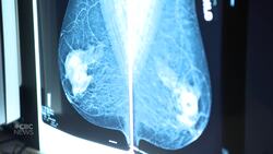 Late cancer diagnoses an impending disaster, experts say News Clip