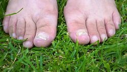 Fungal infection on the nails of the feet. Stock Footage