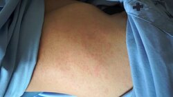 Skin rash is due to dengue. Stock Footage