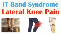 Iliotibial (IT) Band Syndrome (Common Cause of Lateral Knee Pain) |, Symptoms, Diagnosis, Treatment Instructional Video