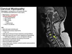 Cauda Equina Syndrome | Presentation, Risk Factors, & Signs/Symptoms Instructional Video