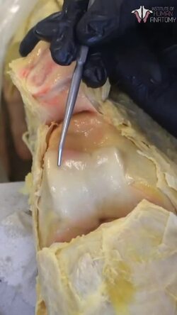 Understanding Cartilage and Arthritis in the Knee Instructional Video