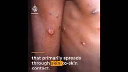 WHO declares monkeypox a global health emergency News Clip