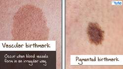 All About Birthmarks: Types, Causes, and Common Myths Instructional Video