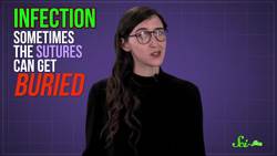 What Happens If You Leave Stitches in for Too Long? Instructional Video