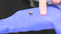 Follow these tips to protect yourself during tick season News Clip