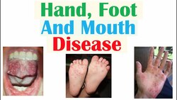 Hand, Foot and Mouth Disease | Viruses, Pathophysiology, Signs and Symptoms, Diagnosis, Treatment Instructional Video